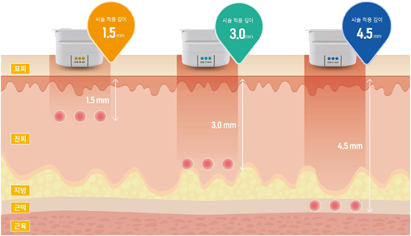 피부층별 시술 적용 깊이: 표피·진피·지방·근막·근육 (1.5/3.0/4.5mm)